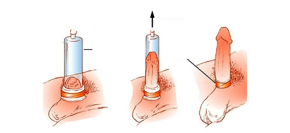 cómo funciona una bomba de vacío para agrandar el pene