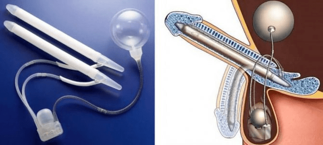 faloprostética para el agrandamiento del pene