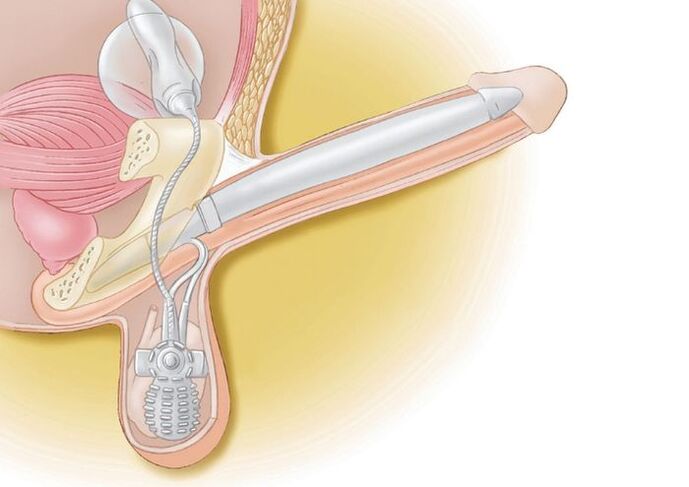 prótesis de pene para agrandar