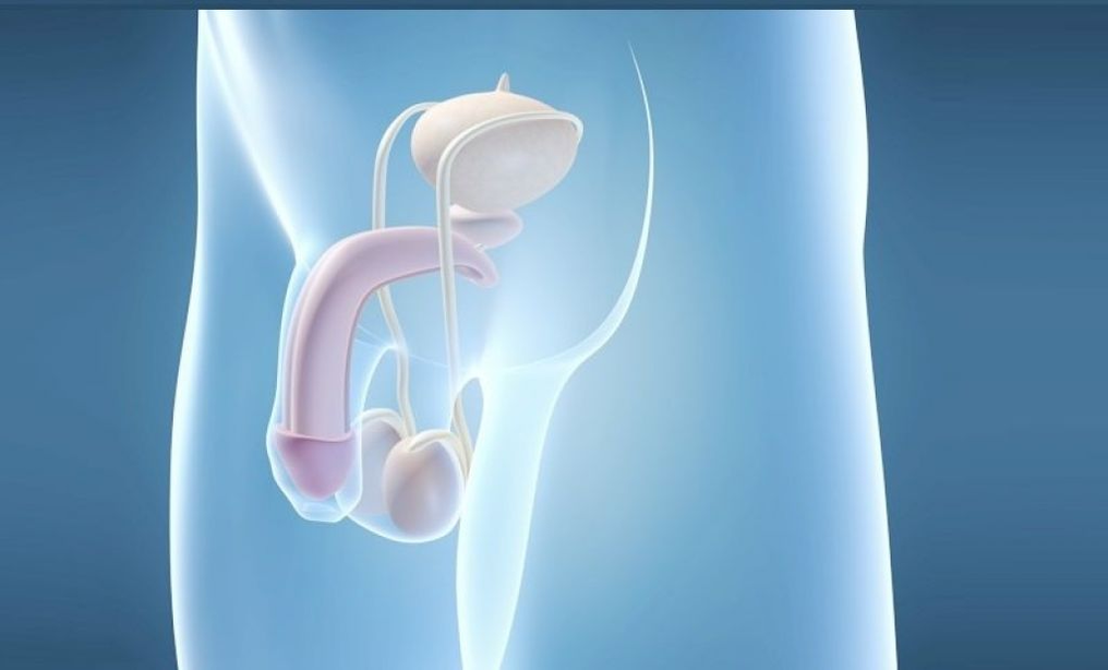 La implantación de prótesis es un método quirúrgico para agrandar el pene masculino. 