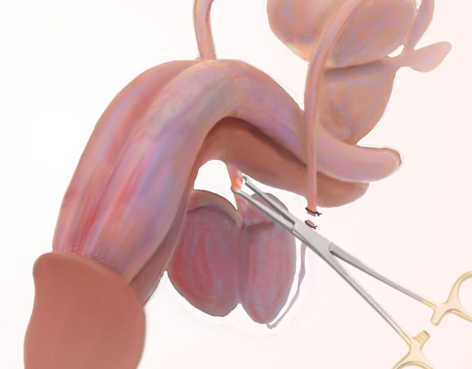 ligamentotomía para agrandar el pene