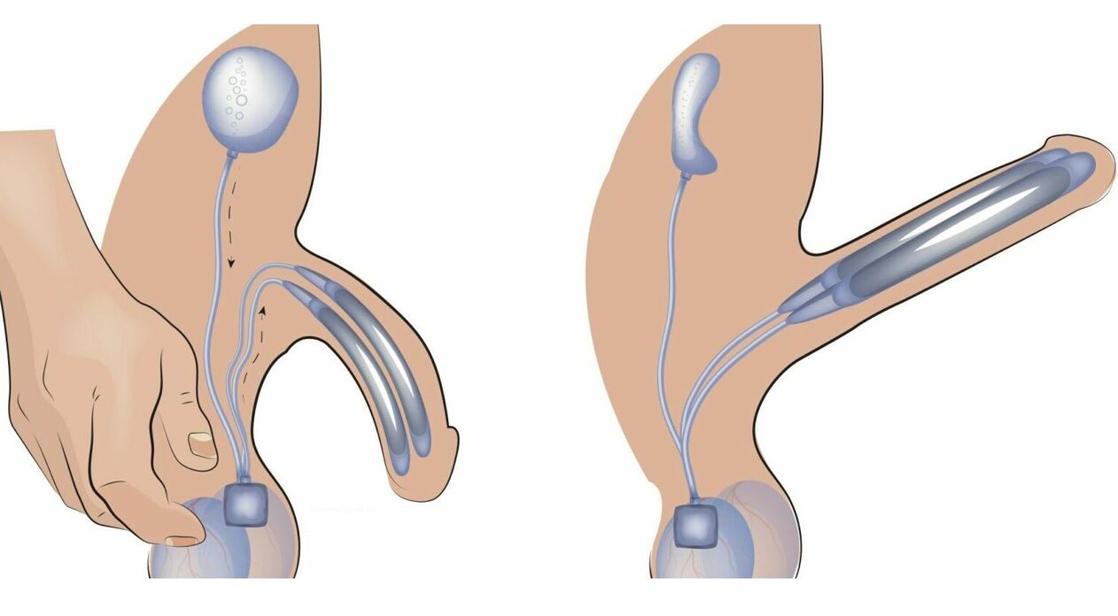 prótesis de pene para agrandar el pene